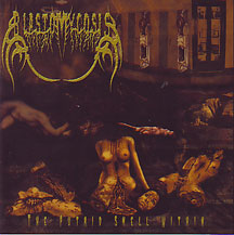 Blastomycosis- The Putrid Smell Within CD on CDN Rec.