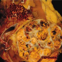 BLASTED PANCREAS- Carcinoma CD on No Label Records