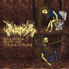Inopexia- Myocardical Biopsy Had A Lethal Outcome CD