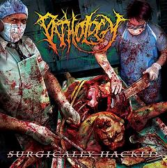 Pathology- Surgically Hacked CD on Amputated Vein Rec.